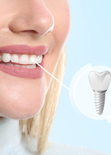 A closeup of a smiling woman’s completed dental implant