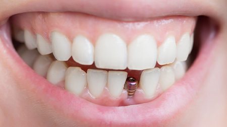 A placed dental implant without its final restoration