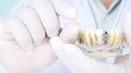 White-gloved hands holding sample dental crown and model jaw with sample dental implant