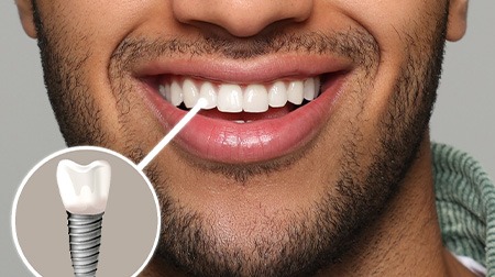 Nose-to-chin view of man smiling with a tooth indicated as implant