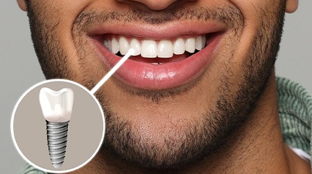 A photo highlighting a bearded man’s complete dental implant