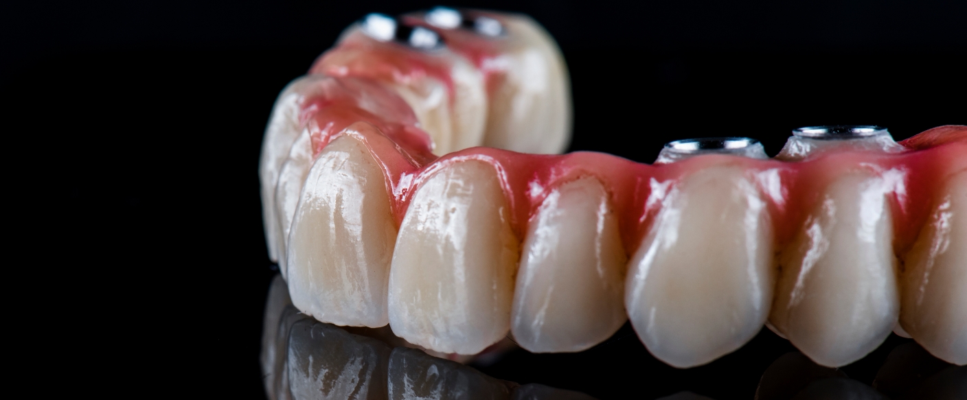 Model of an All on 4 implant denture in Tampa