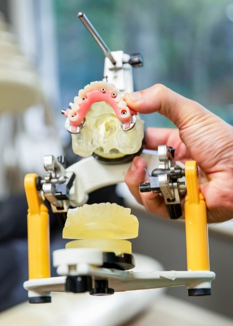 Hand holding a model of All on 4 dental implants
