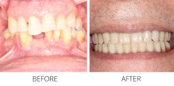 Close up of a mouth before and after replacing a missing lower tooth