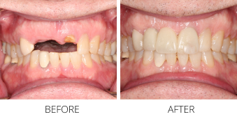 Close up of a mouth before and after replacing a few missing upper teeth