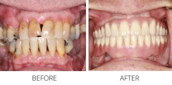 Close up of a mouth before and after replacing damaged teeth with dental implants
