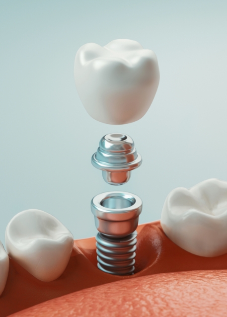 Illustration of a dental implant with a crown being placed into the lower jaw