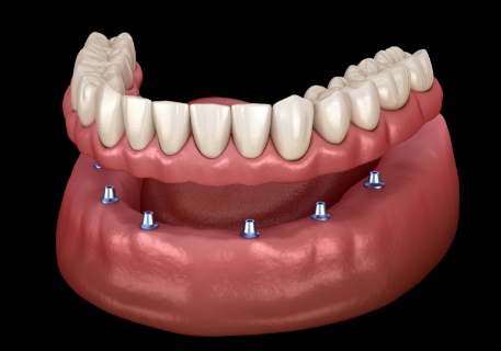 Illustrated full denture being placed onto six dental implants