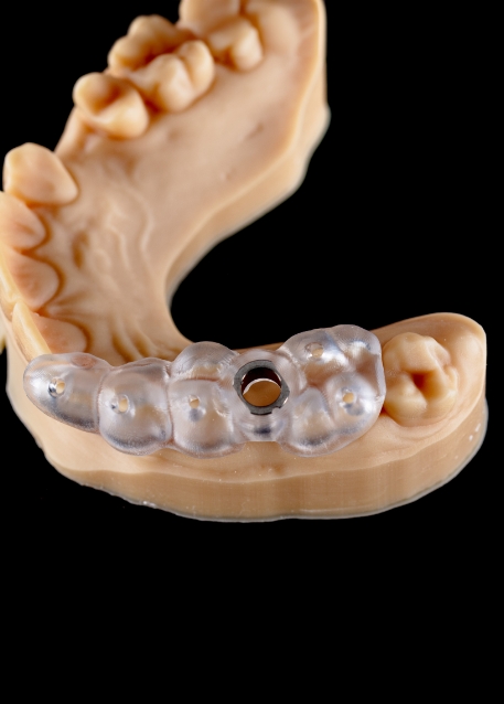 Model of the teeth with a surgical guide for dental implant placement