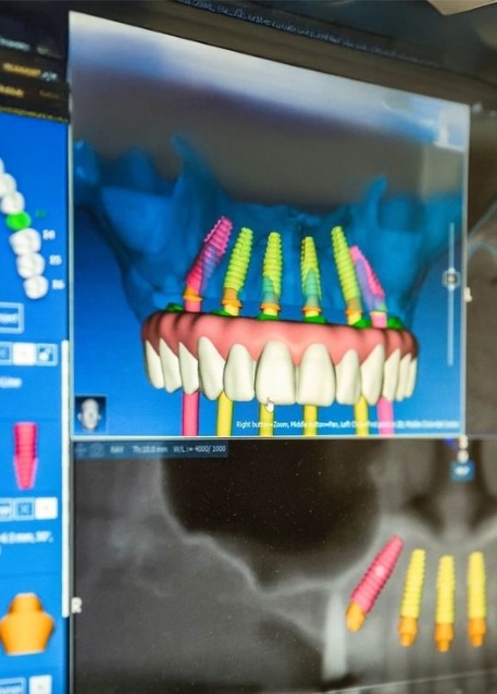 Screen showing a digital model of a row of teeth