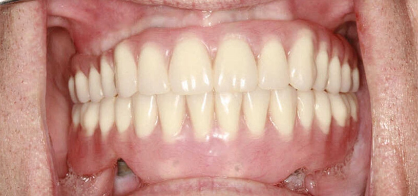 Close up of a mouth full of flawless white teeth