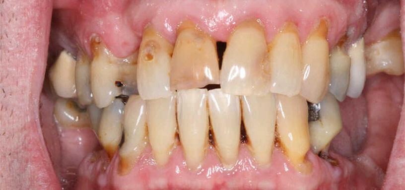 Close up of a mouth with several damaged and discolored teeth