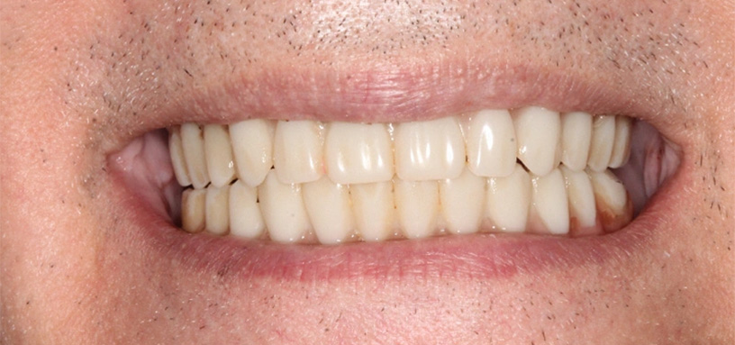 Close up of a mouth after replacing a missing lower tooth