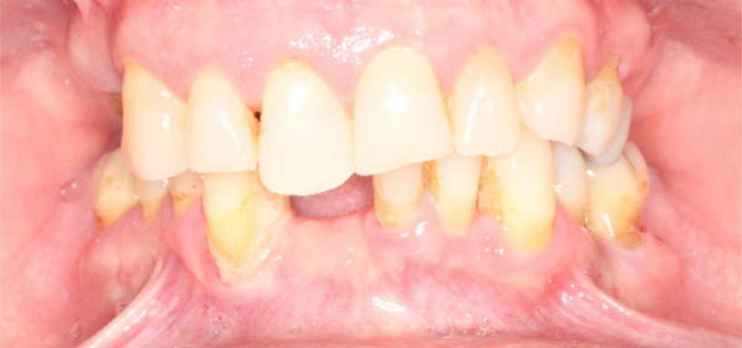 Close up of a mouth with a missing lower tooth