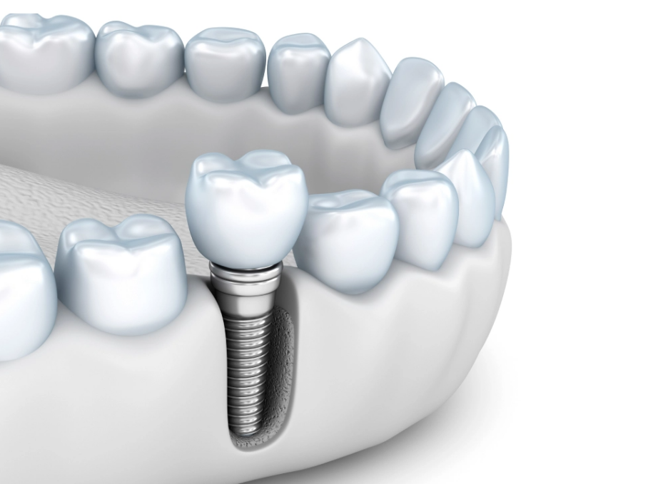 Digital illustration of a dental implant replacing a missing lower tooth