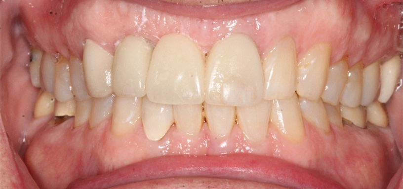 Close up of a mouth after replacing missing upper teeth