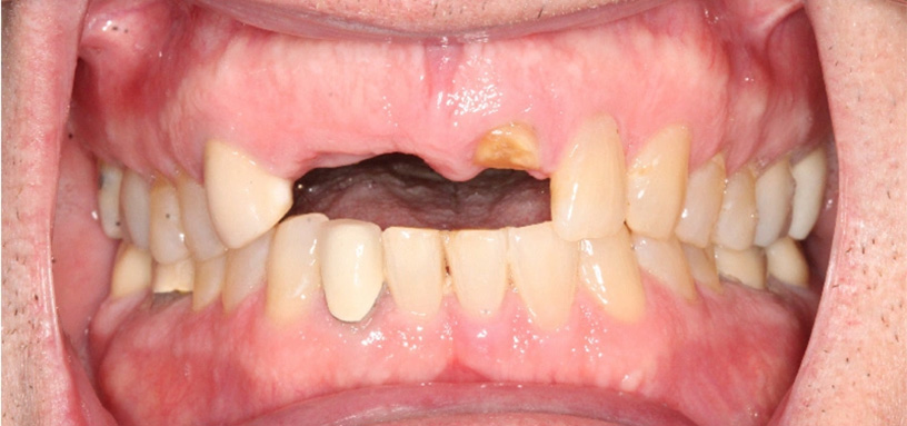 Close up of a mouth with several missing upper teeth