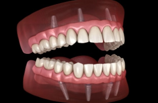 Illustration of a mouth with All on 4 implant dentures on both arches