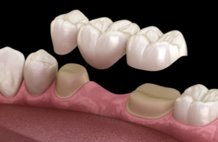 Illustration of a dental bridge replacing a missing tooth