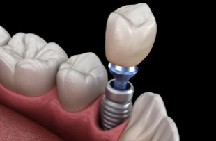 Illustration of a dental implant with a crown being placed in the lower jaw