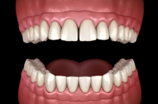 Illustration of a mouth with dentures on both arches