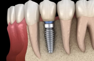 Illustration of a single dental implant in the lower jawbone