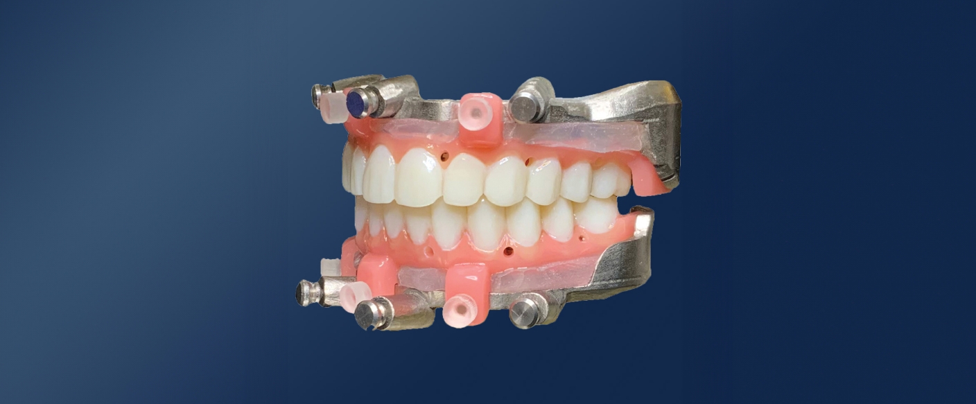 Model of the mouth with surgical guides for dental implant placement